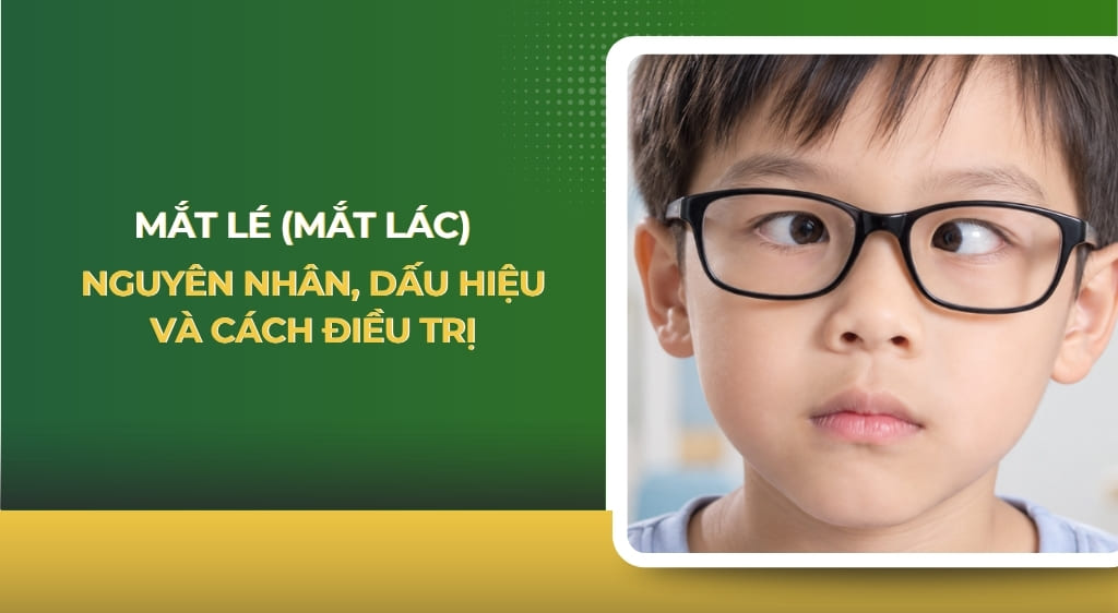 Mắt lé