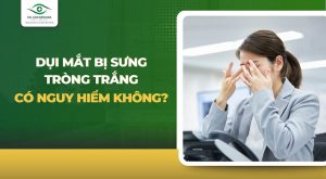 Dụi mắt bị đỏ mắt