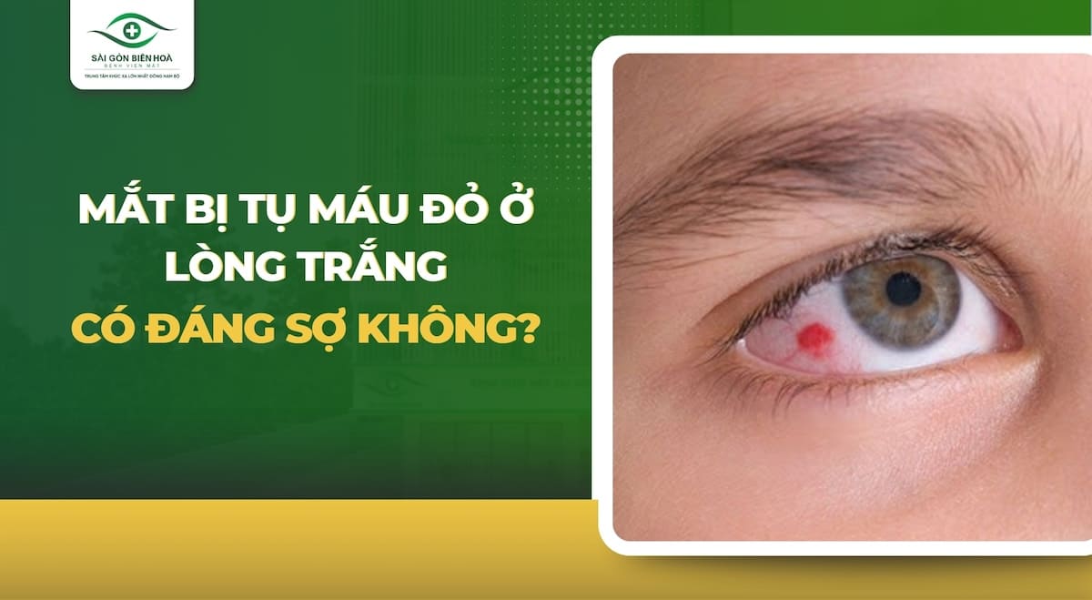 Mắt bị tụ máu ở tròng trắng