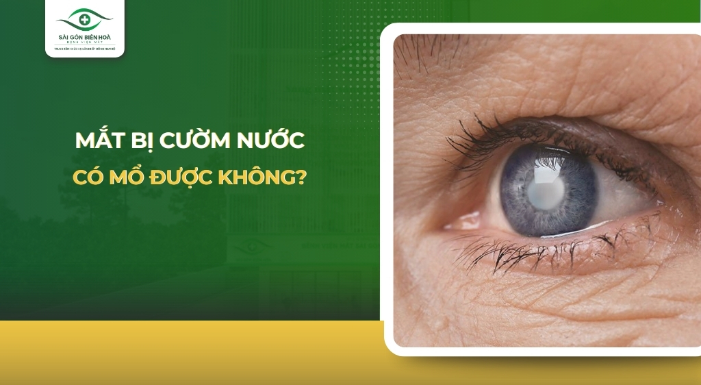 mắt bị cườm nước