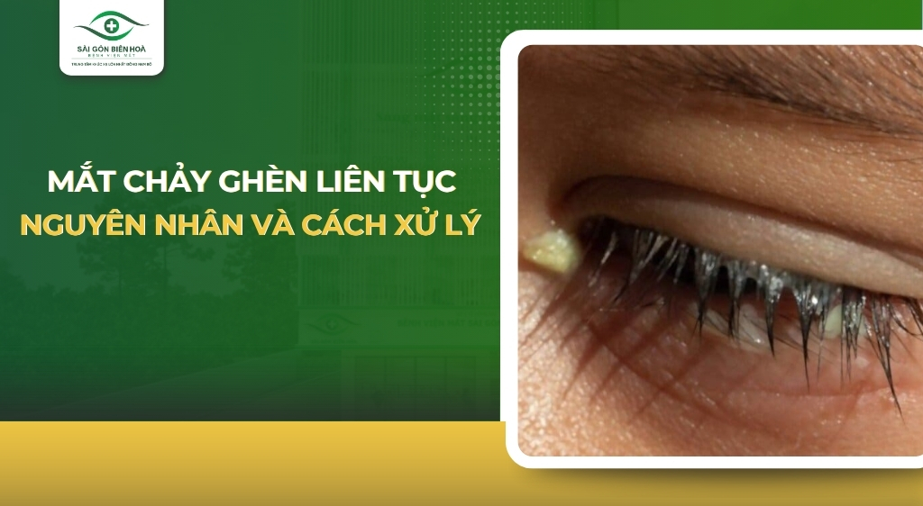 Mắt chảy ghèn liên tục