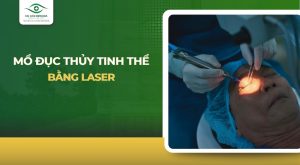 Mổ đục thủy tinh thể bằng Laser