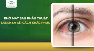 khô mắt sau phẫu thuật lasik