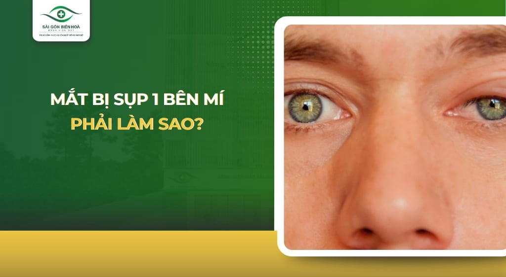 mắt bị sụp 1 bên mí phải làm sao