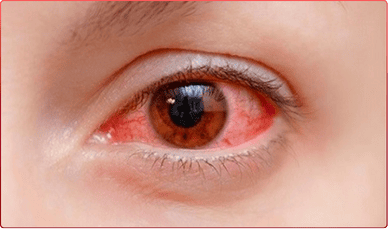 Mắt người bệnh bị thoái hóa điểm vàng