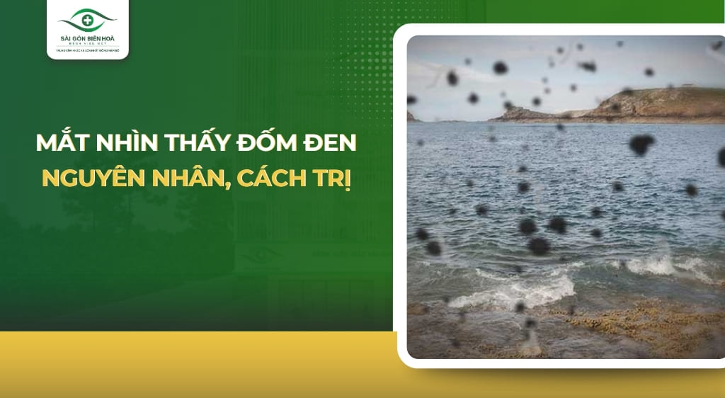 mắt nhìn thấy đốm đen