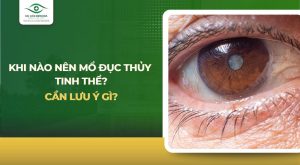Khi nào nên mổ đục thủy tinh thể