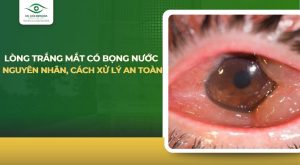 lòng trắng mắt có bọng nước