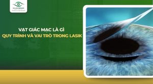 Vạt giác mạc là gì