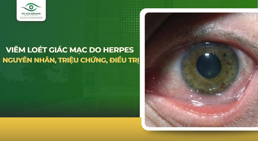 Viêm loét giác mạc do herpes