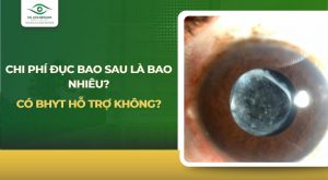 Chi phí mổ đục bao sau