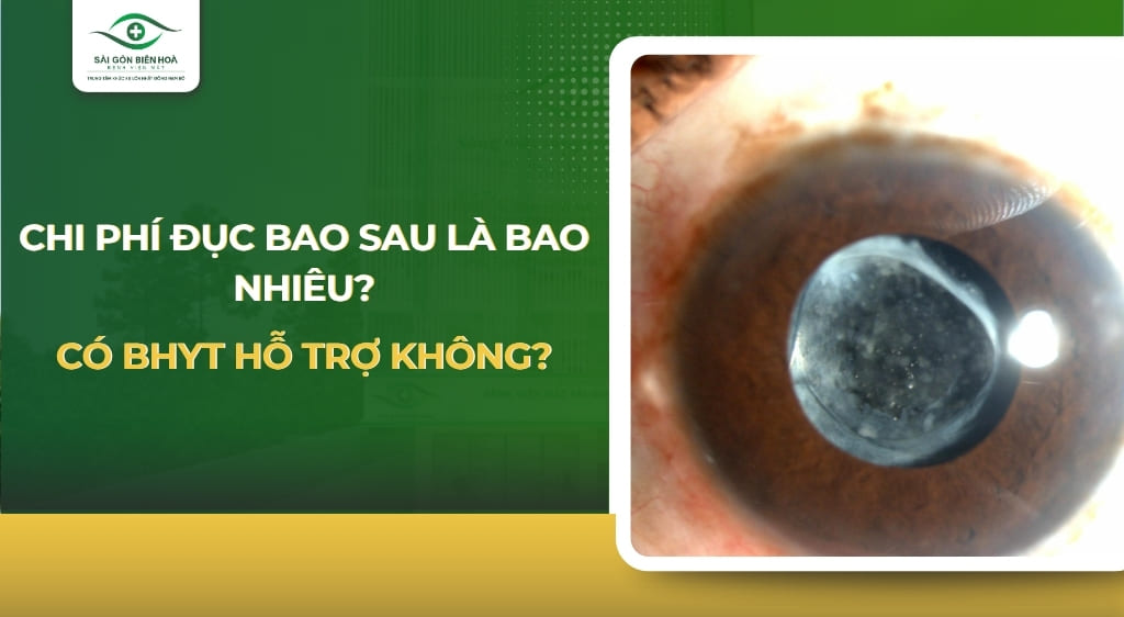 Chi phí mổ đục bao sau