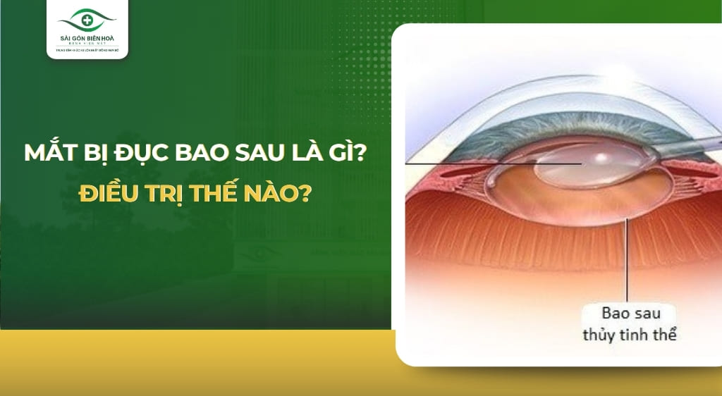đục bao sau