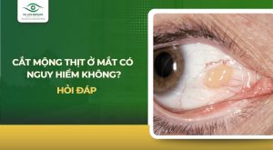 cắt mộng thịt ở mắt có nguy hiểm không