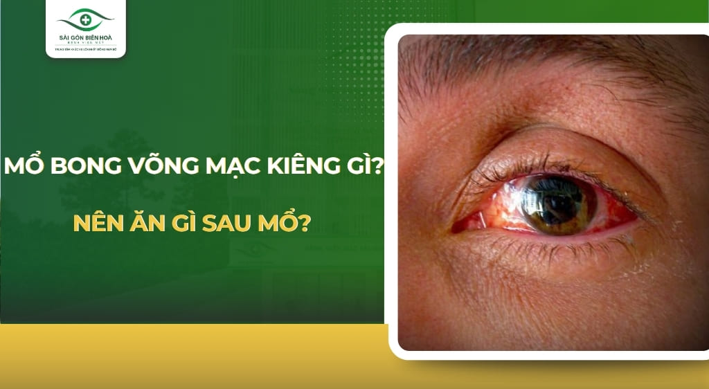 Mổ bong võng mạc kiêng gì
