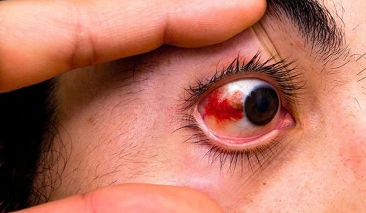 Bệnh võng mạc là tổn thương do tiểu đường hoặc cao huyết áp, gây mờ hoặc mất thị lực