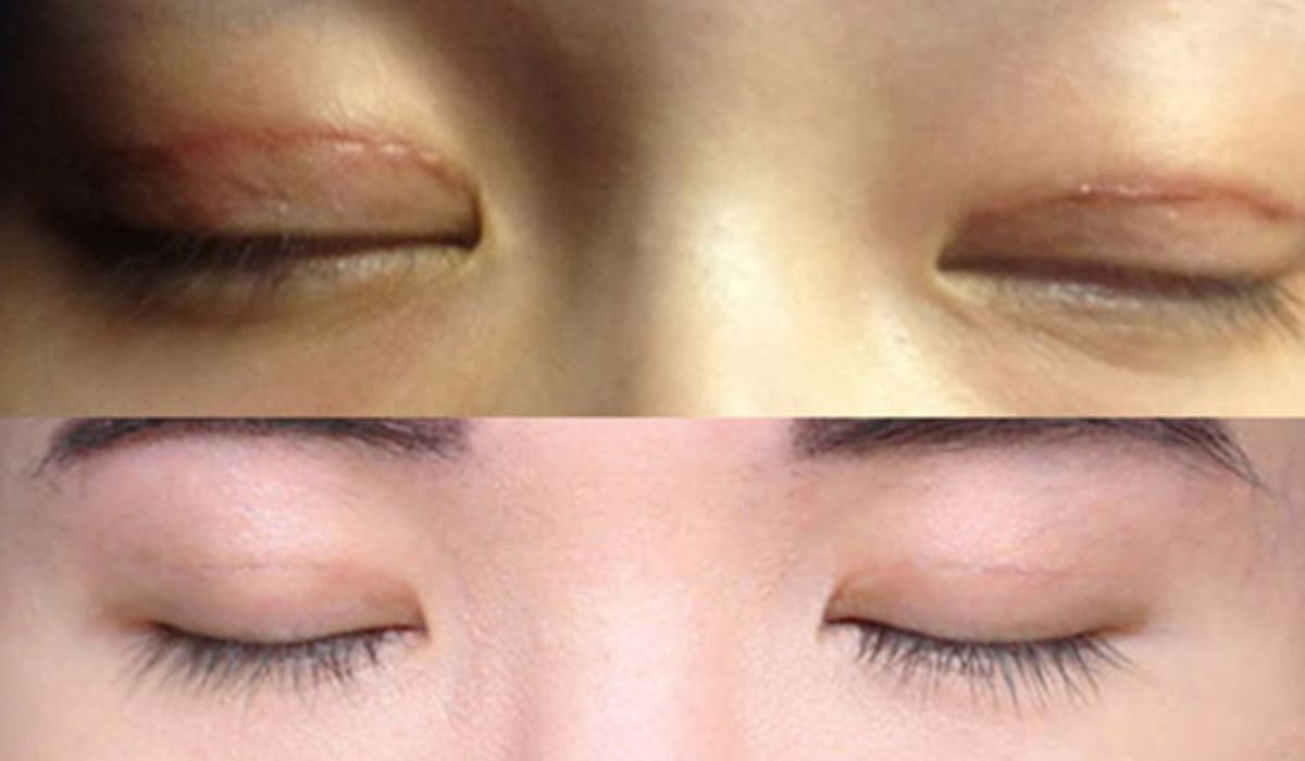 Biến chứng sẹo lồi sau cắt da thừa mí mắt có thể ảnh hưởng thẩm mỹ và tâm lý người bệnh