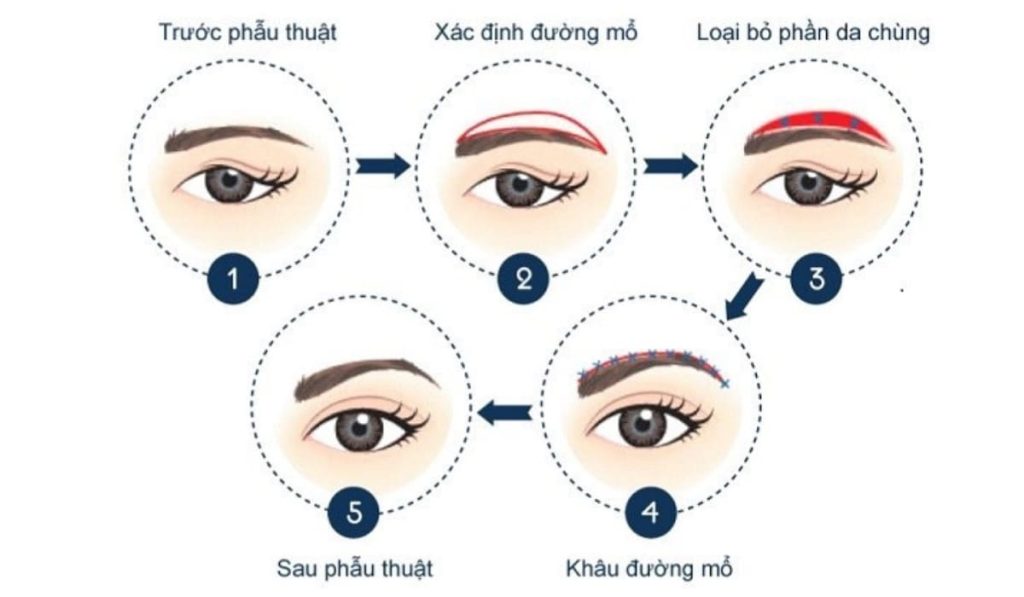 Các quy trình thực hiện phẫu thuật nâng cung lông mày