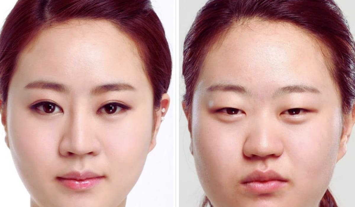 Can thiệp thẩm mỹ vùng mí hỗ trợ gương mặt thêm sáng bừng và lôi cuốn