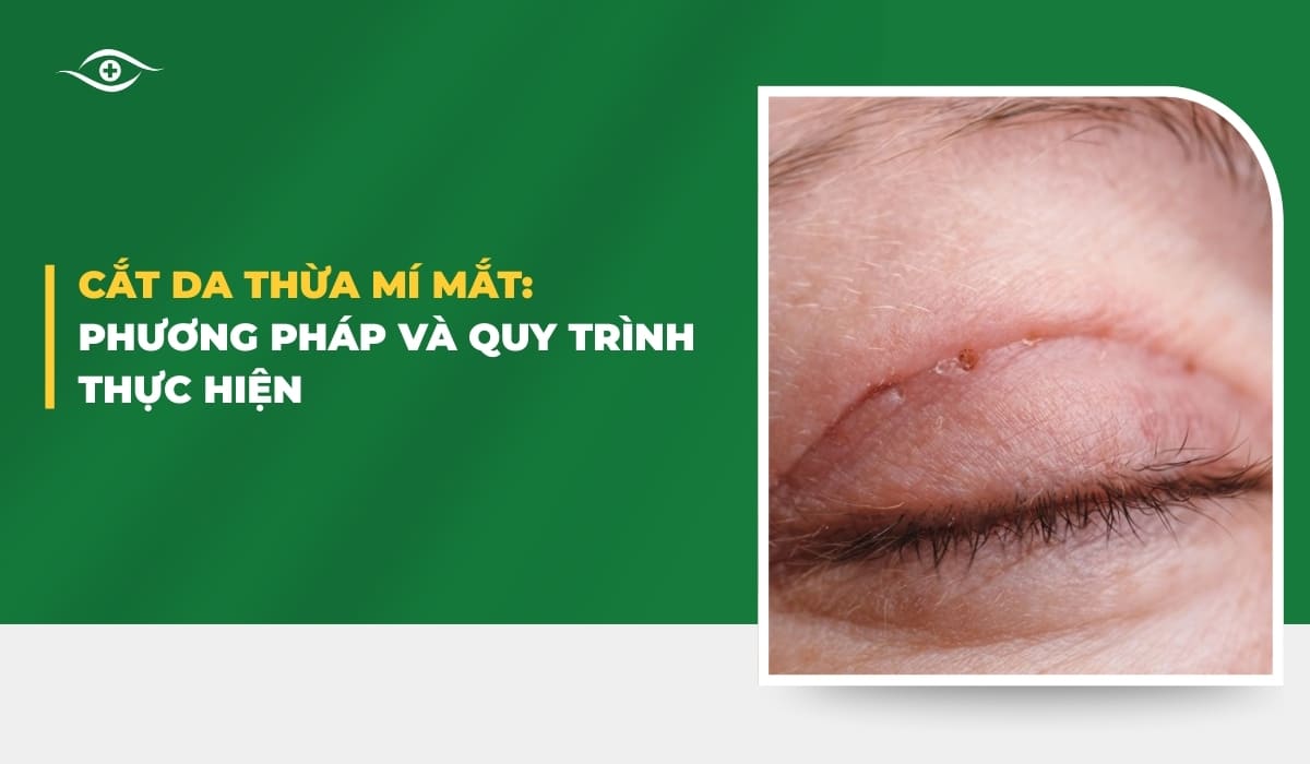 Cắt da thừa mí mắt