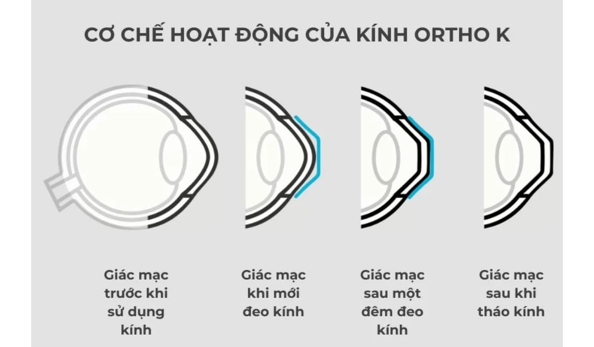 Cơ chế hoạt động của kính Ortho-K