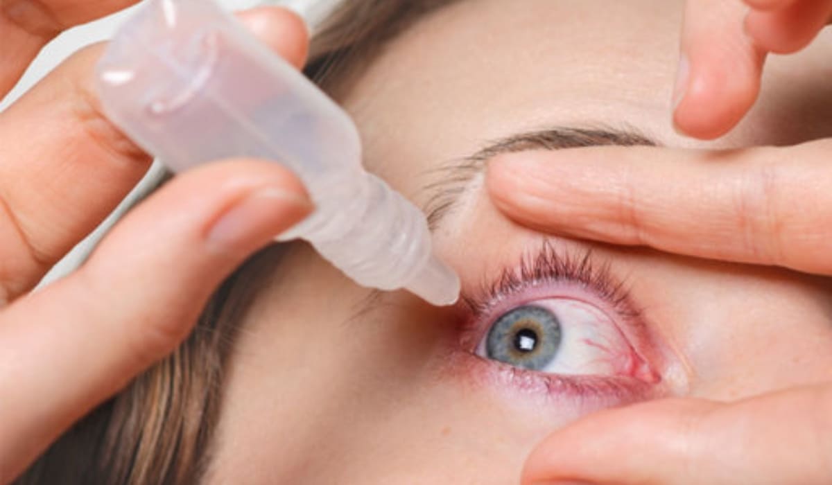 Dùng thuốc nhỏ mắt kháng sinh và chống viêm theo chỉ định bác sĩ, không tự ý thay đổi liều.