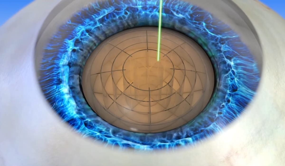 Hình ảnh minh họa quy trình phẫu thuật Laser Cataract