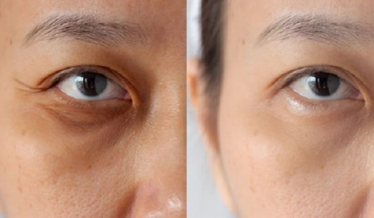 Hình ảnh trước và sau khi tiêm Botox xóa nhăn giúp đôi mắt đẹp hơn