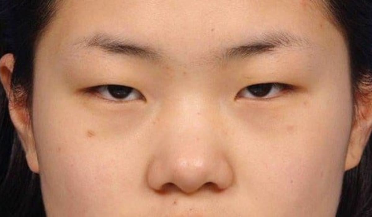 Mắt 1 mí khiến nhiều người thiếu tự tin trên khuôn mặt của bản thân