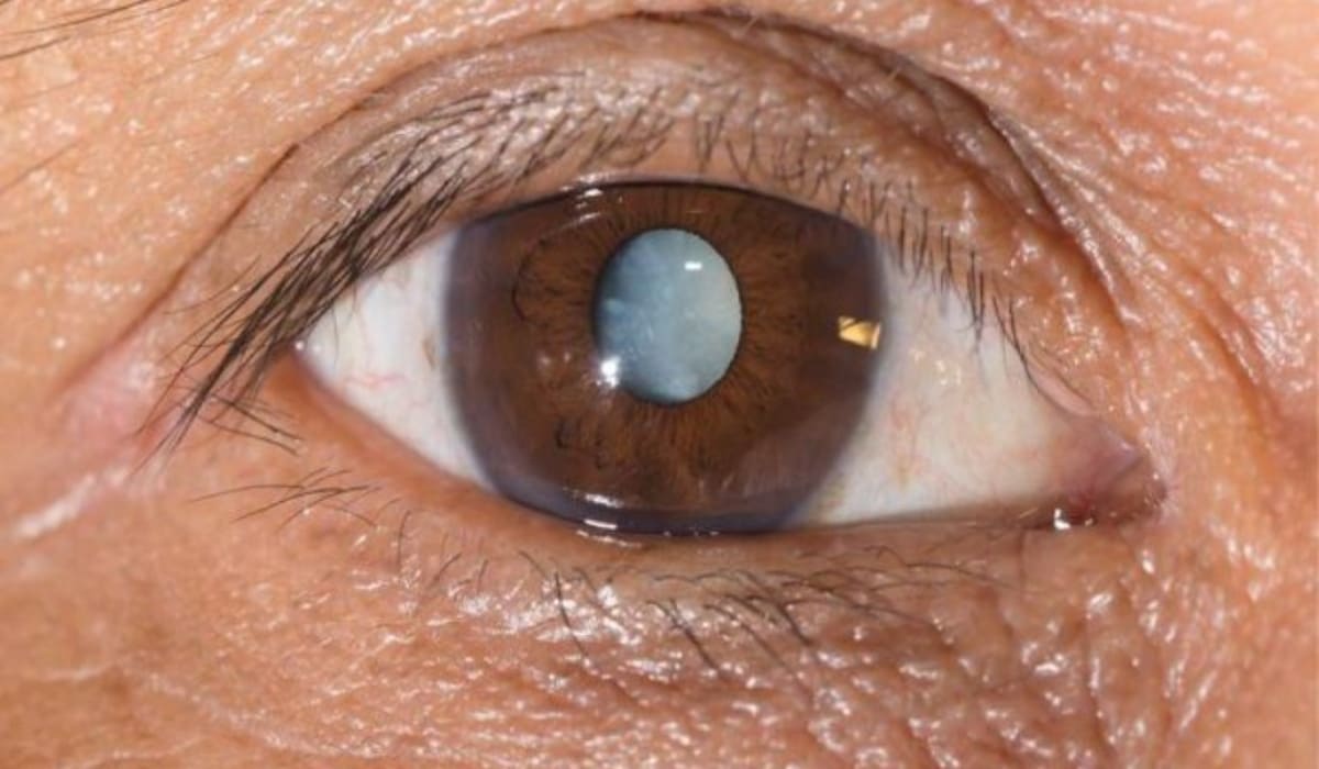 Mổ mắt cườm nước là phẫu thuật giảm áp lực mắt để điều trị bệnh glôcôm