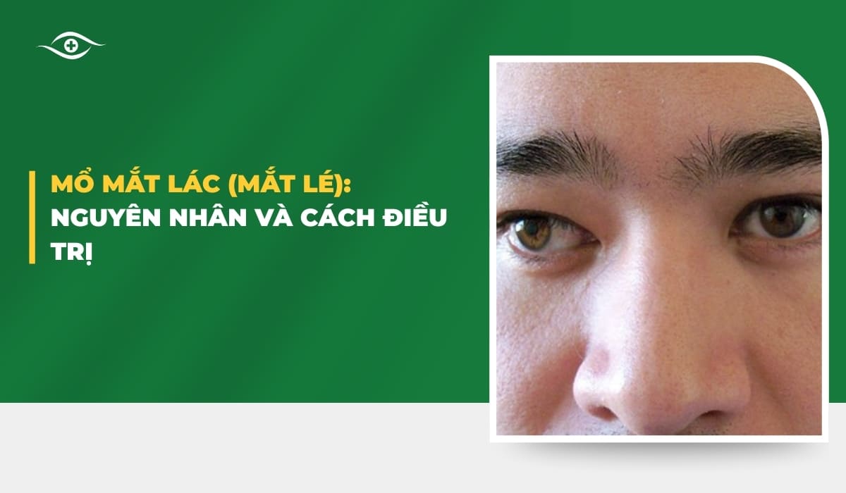 mổ mắt lác