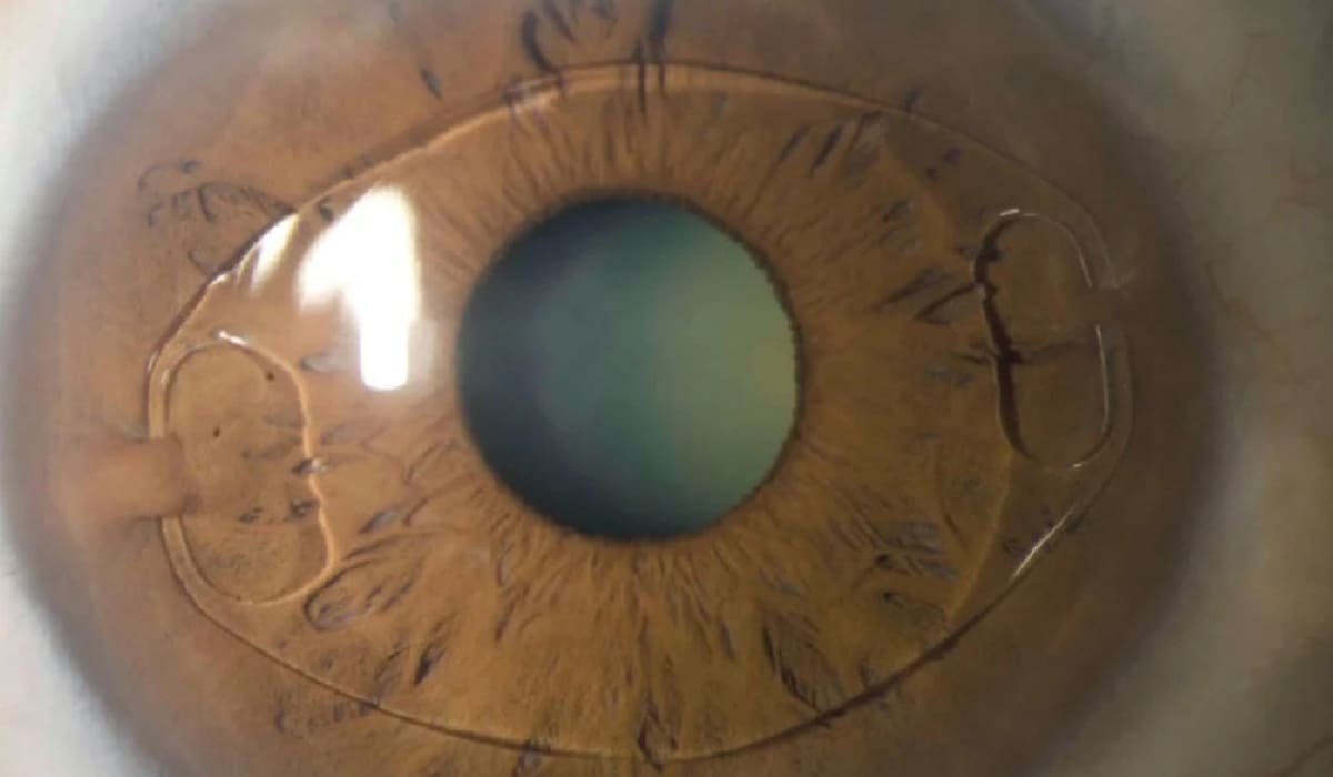 Mổ mắt Phakic IPCL bảo tồn hoàn toàn độ dày và hình thái giác mạc, giúp duy trì sự ổn định quang học tự nhiên của mắt