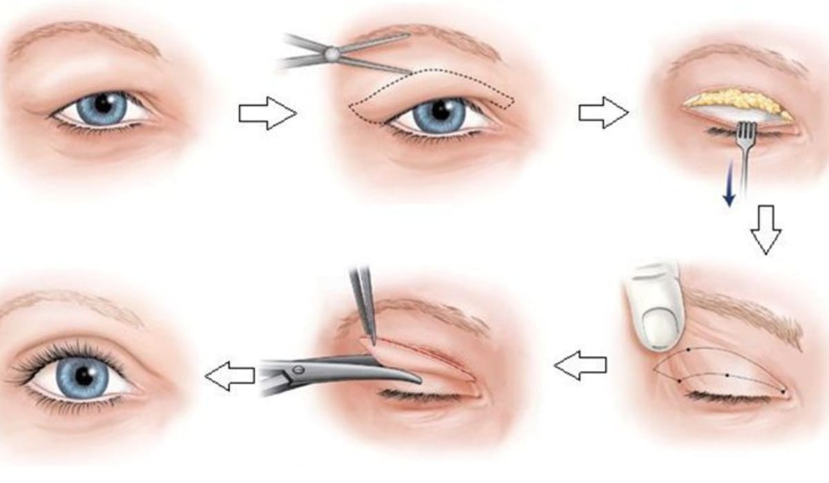Mỗi bước trong phẫu thuật cắt mí đều được kiểm soát nghiêm ngặt để mang lại kết quả tối ưu và an toàn cho người bệnh

