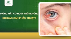 mộng mắt có nguy hiểm không