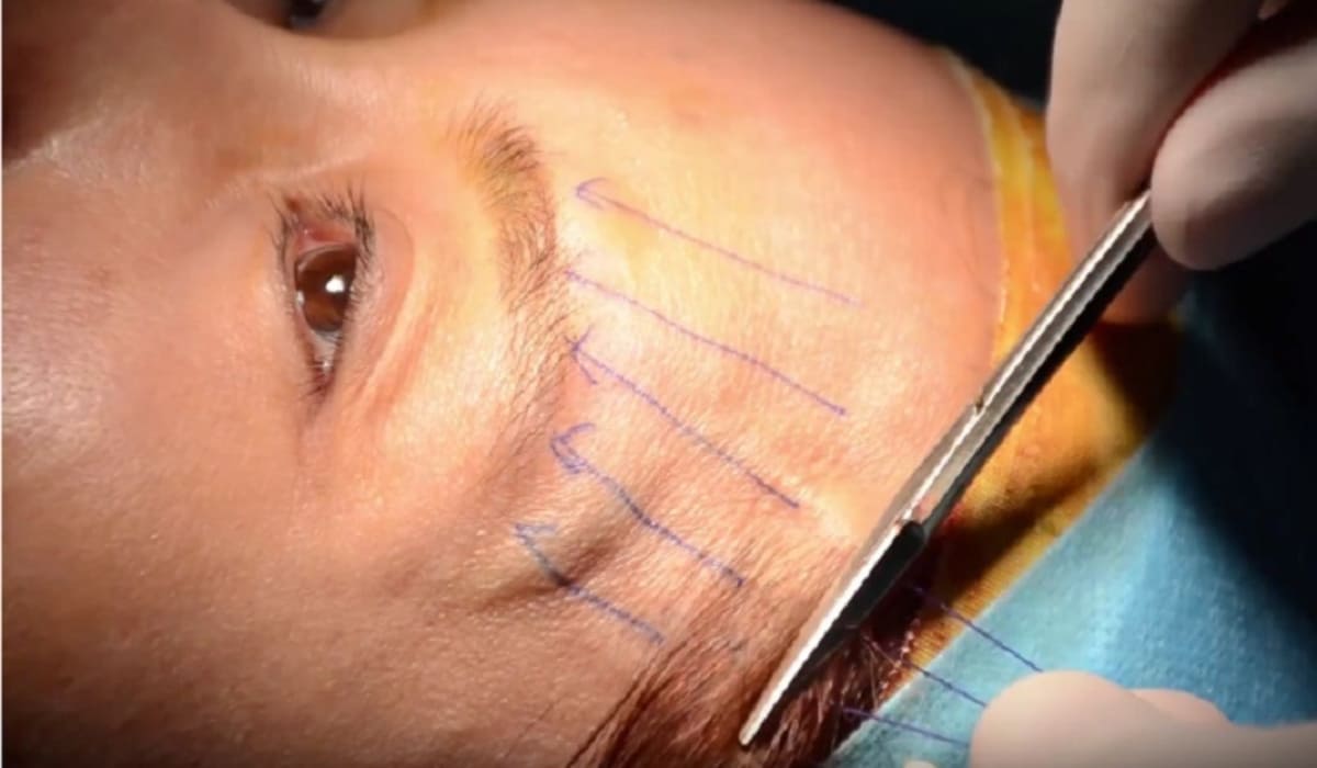 Nâng cung lông mày giúp trẻ hóa vùng mắt, xóa mờ nếp nhăn đuôi mắt