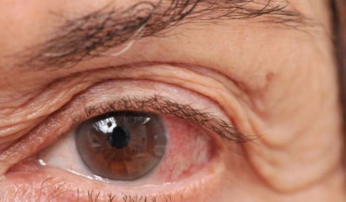 Người bị glôcôm nặng, không đáp ứng thuốc hoặc thị lực giảm dần chỉ định mổ cườm nước