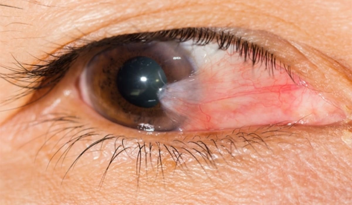 Người bị mộng thịt từ cấp độ 2 trở lên sẽ cần phẫu thuật