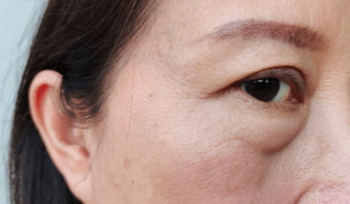 Người sau 40 tuổi thường gặp da mí trên chùng nhão, chân mày hạ thấp, gây sụp mí và giảm tầm nhìn.