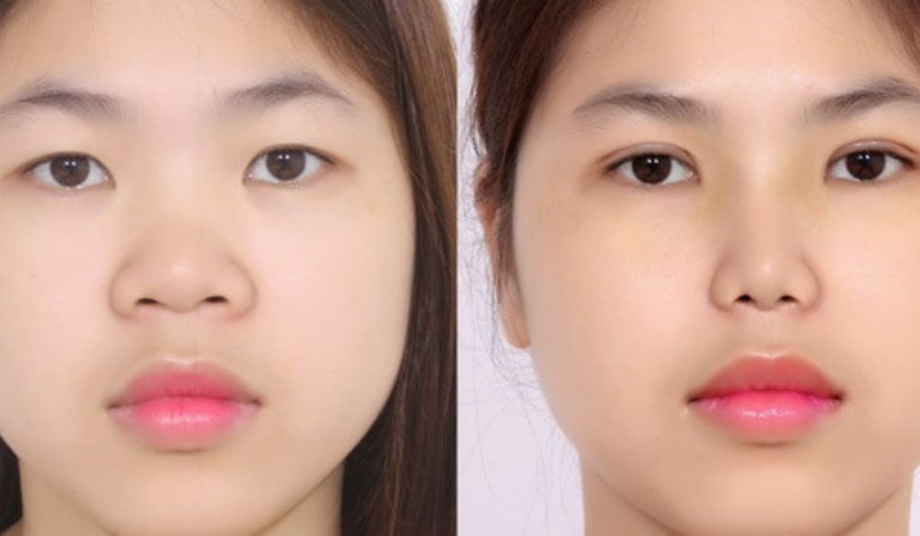 Nhờ cắt mí mắt, đôi mắt trở nên linh hoạt hơn, tạo điểm nhấn cho gương mặt thêm tươi tắn và tự tin