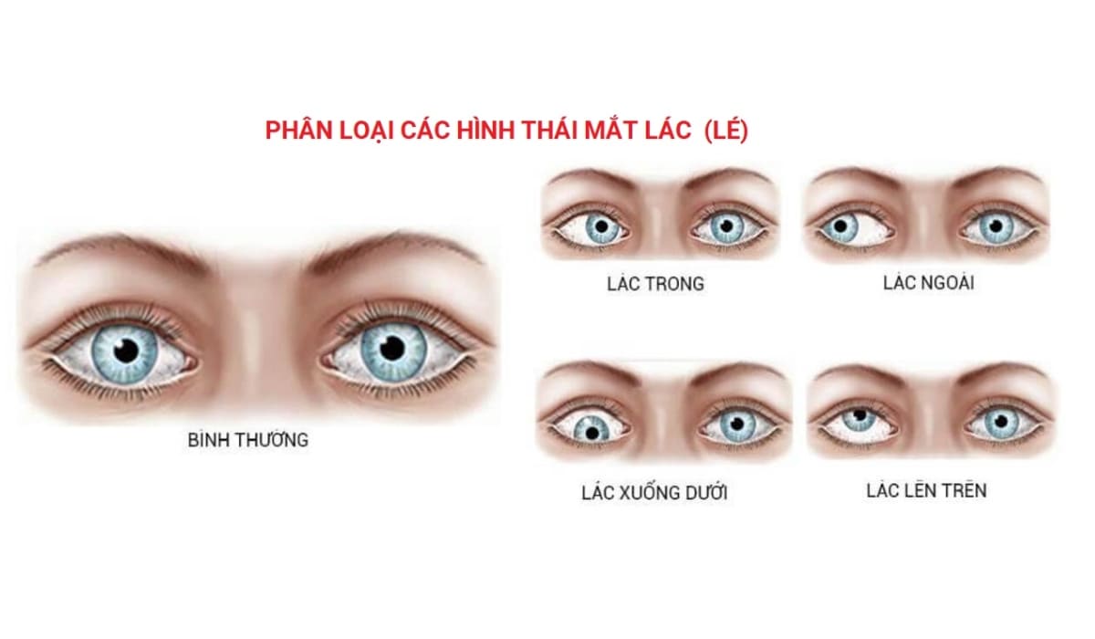 Phân loại các dạng mắt lác