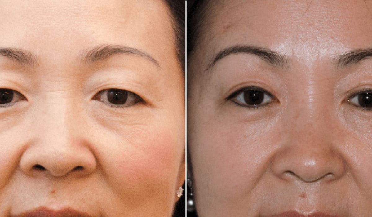 Phẫu thuật cắt da thừa mí mắt giúp khuôn mặt trẻ hóa, trẻ trung hơn