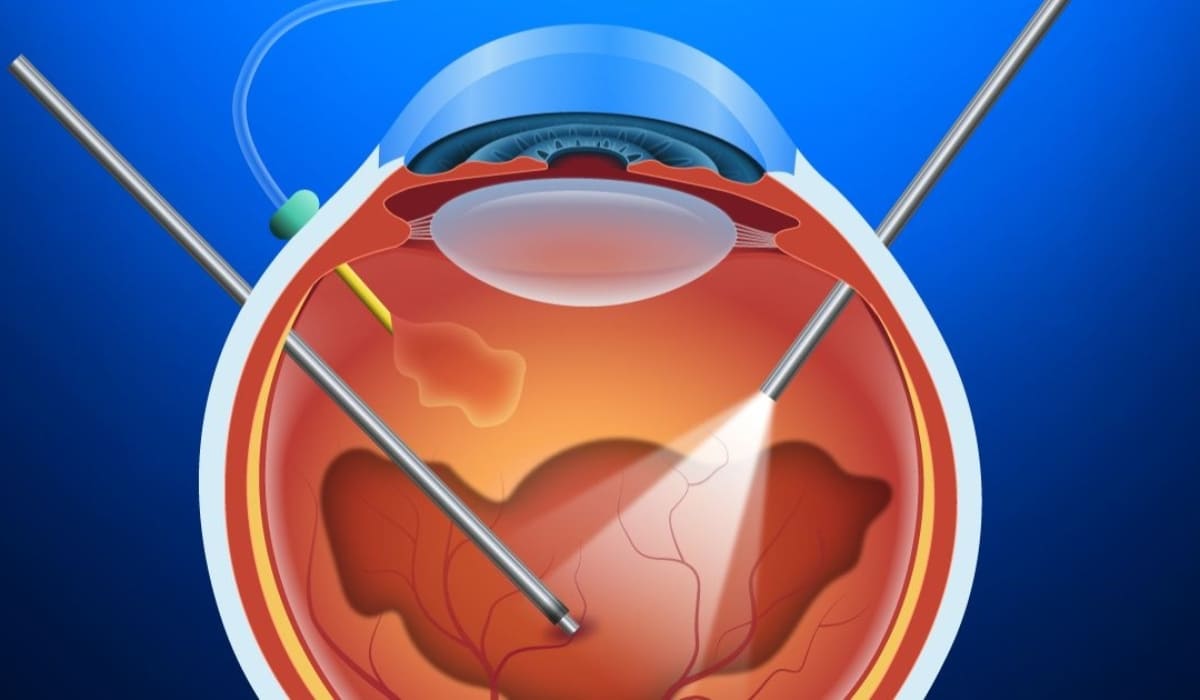 Phẫu thuật cắt dịch kính giúp điều trị bệnh mắt và cải thiện thị lực