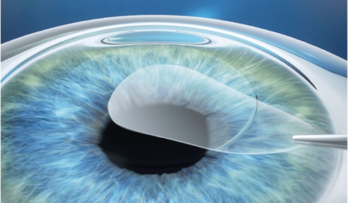 Phẫu thuật CLEAR: laser tạo và lấy lenticule qua rạch 2mm để chỉnh giác mạc