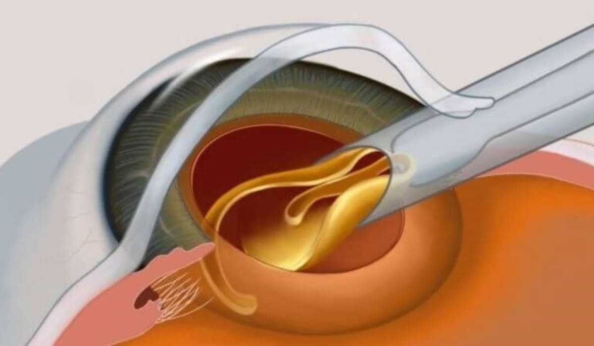 Phẫu thuật đục thủy tinh thể bằng phương pháp Phaco có nhiều ưu điểm vượt trội