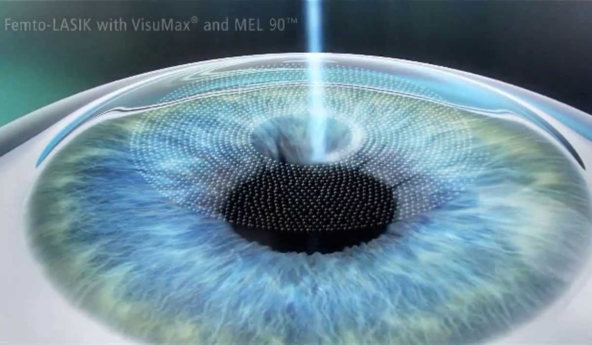Phẫu thuật Femto Pro với laser Femtosecond tạo vạt giác mạc và laser Excimer chỉnh sửa giác mạc