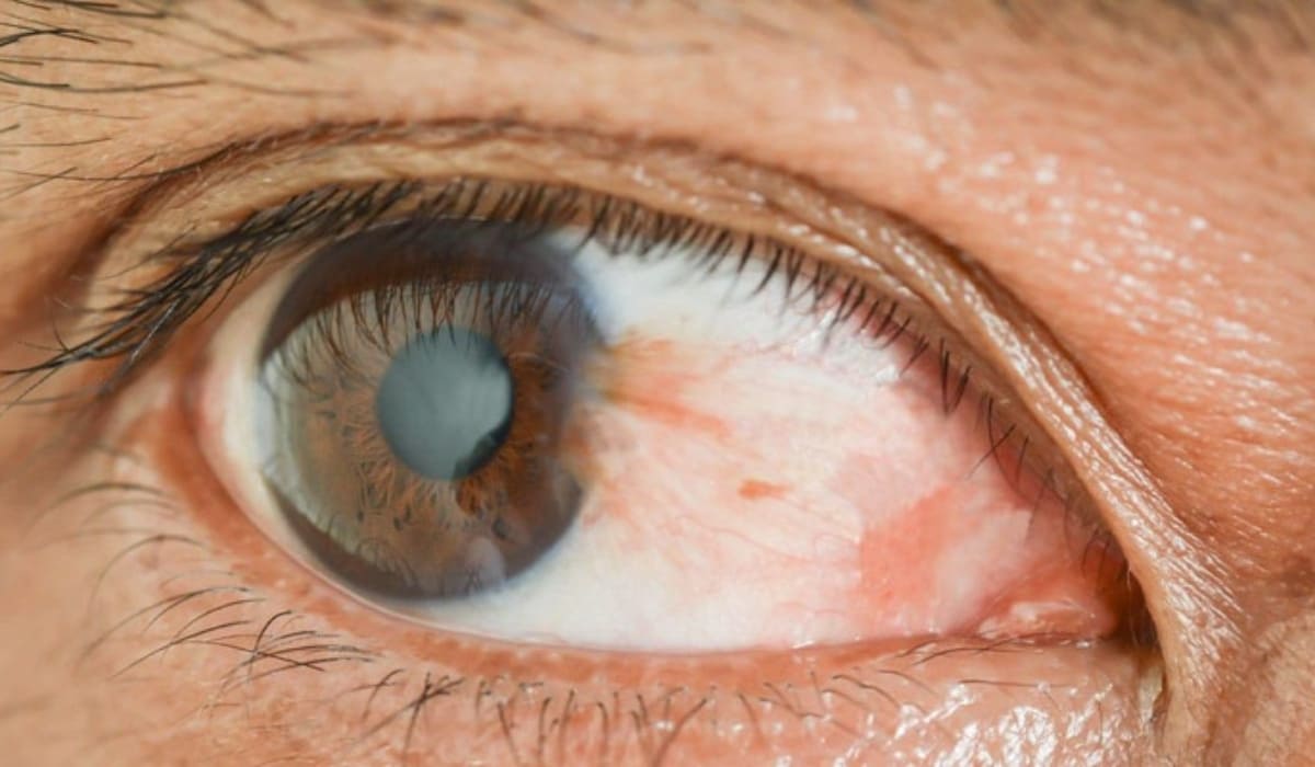 Phẫu thuật mộng thịt phổ biến là cắt mộng kèm ghép kết mạc tự thân, giúp hạn chế tái phát