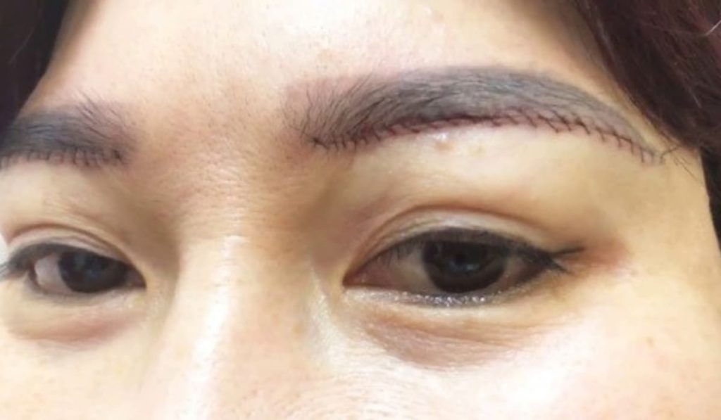 Phẫu thuật nâng cung lông mày giúp trẻ hóa vùng mắt, khắc phục tình trạng sụp mí hiệu quả