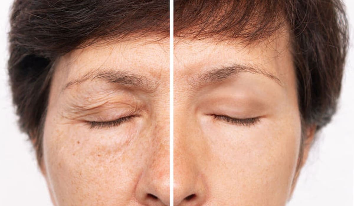 Phẫu thuật nâng cung mày giúp làn da khuôn mặt tươi trẻ hơn, đồng thời làm đôi mắt thêm cuốn hút