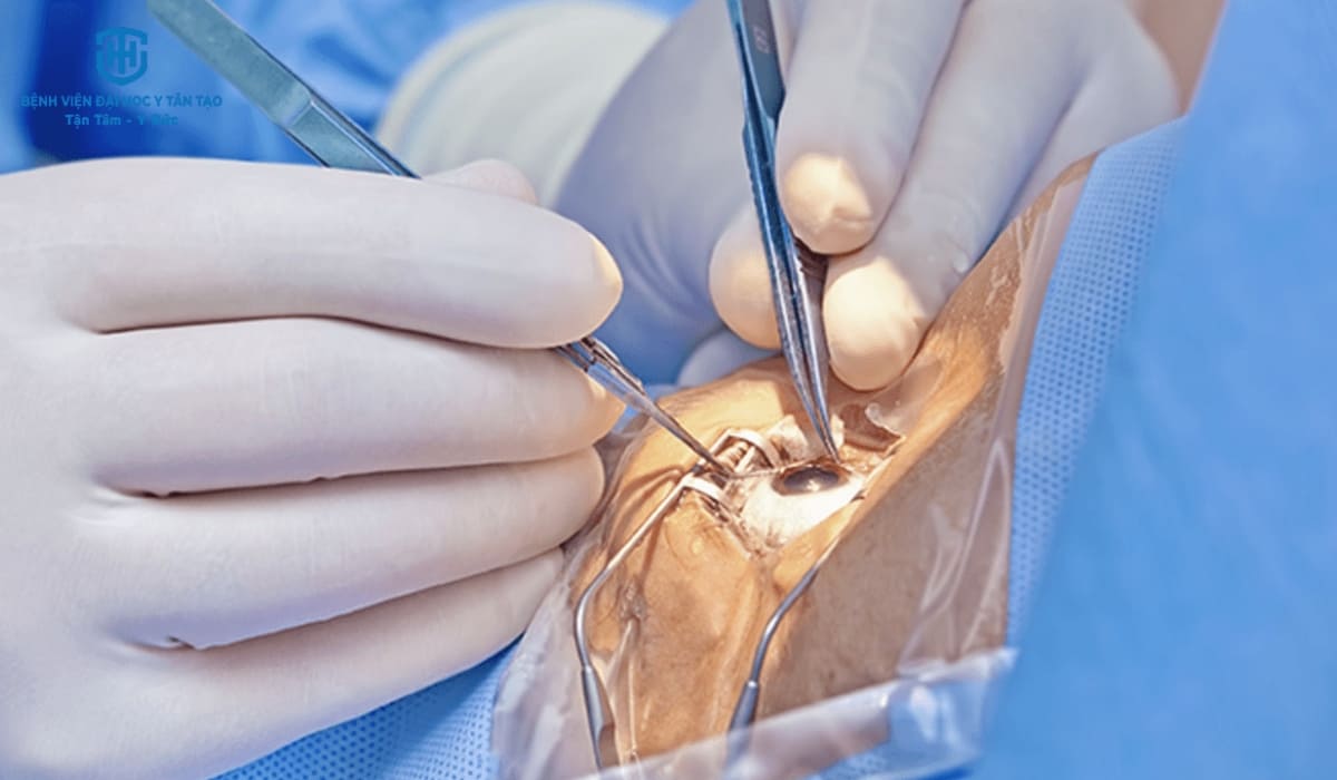 Phẫu thuật Phaco được đánh giá là phương pháp an toàn và hầu như không gây đau cho người bệnh.