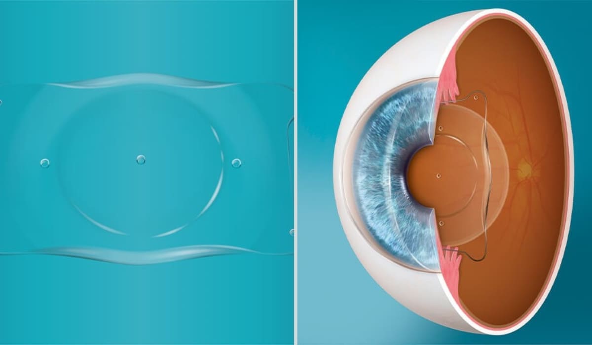 Phương pháp cấy ghép kính nội nhãn Phakic IOL mang lại tầm nhìn sáng rõ